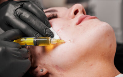 Bellafill, Permanent Facial Filler for Acne Scarring