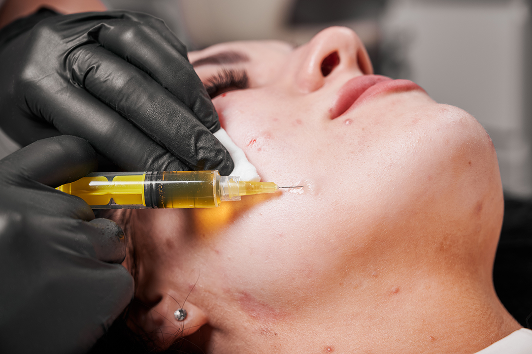 Bellafill Permanent Facial Filler for Acne Scarring blog img