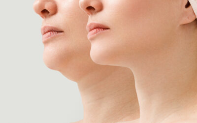 Kybella™: New Injectable for the Dreaded Double Chin