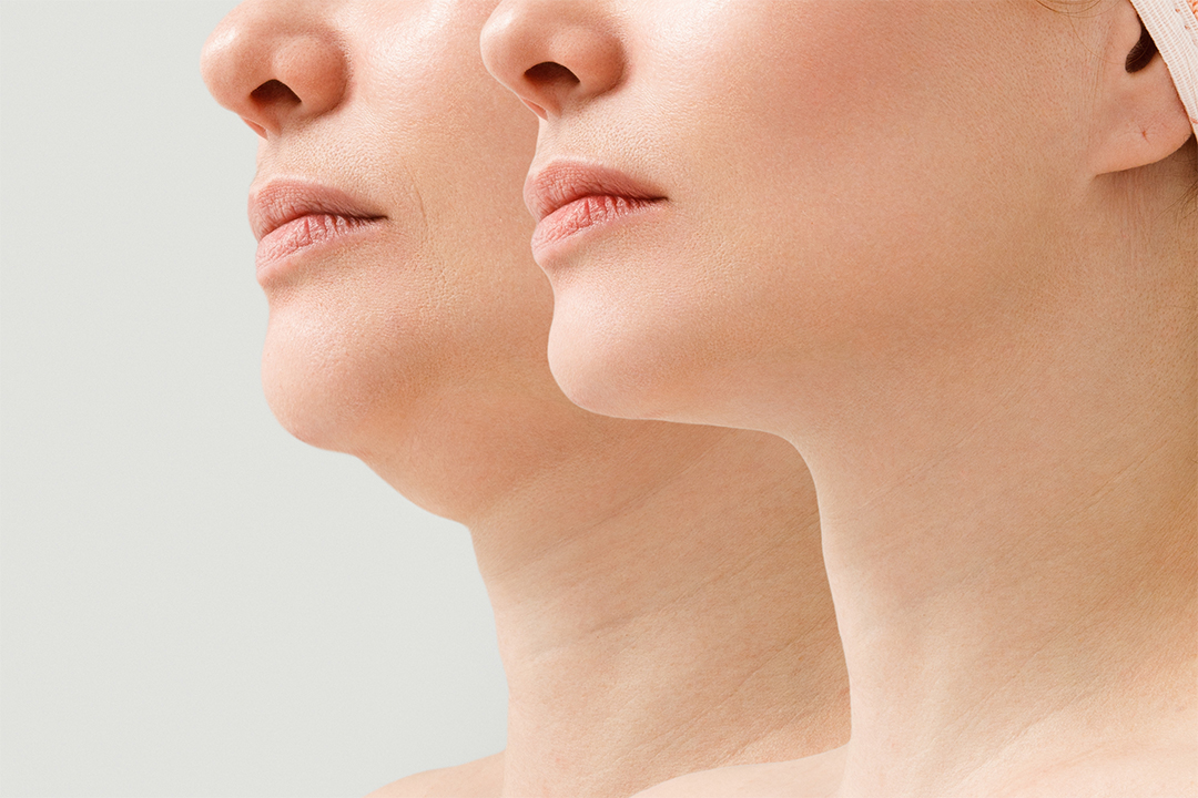 Kybella™ New Injectable for the Dreaded Double Chin blog img