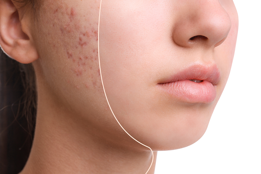 Skin Treatments From Sun Damage to Back to School Acne blog img