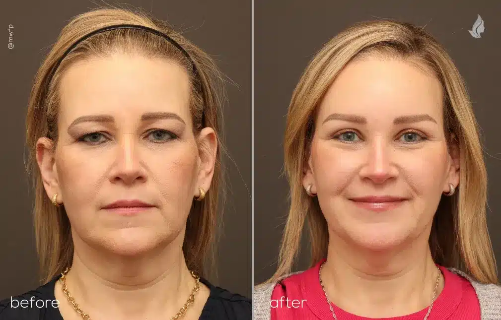 Front View Blepharoplasty and Brow Lift before and after photo by Dr. Bakeman