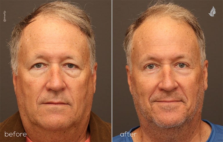 Front View Blepharoplasty and Brow Lift before and after photo by Dr. Tolan