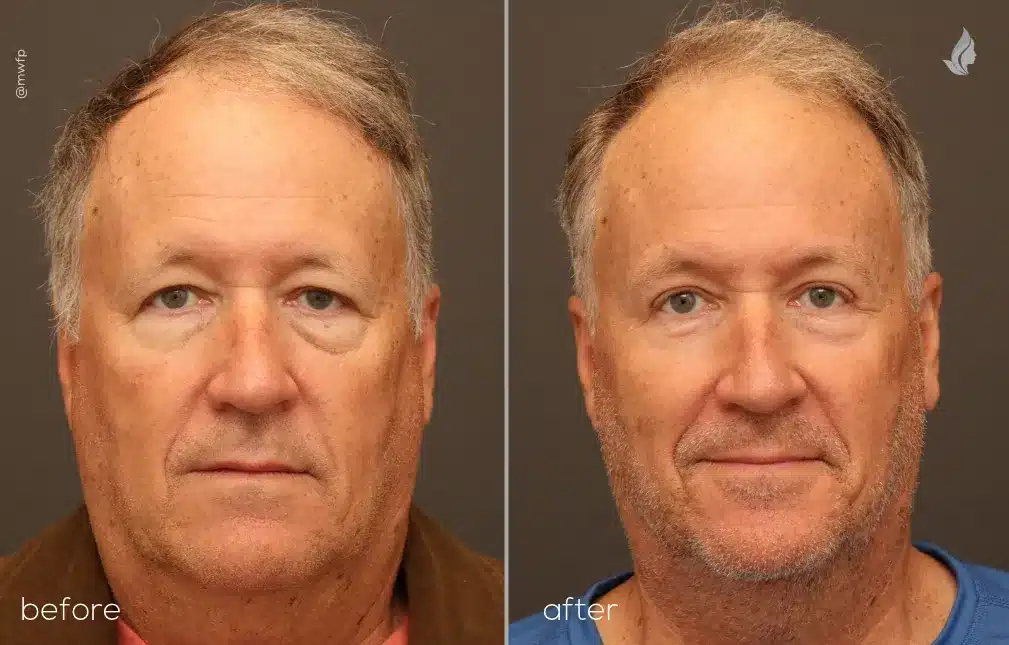 Front View Blepharoplasty and Brow Lift before and after photo by Dr. Tolan
