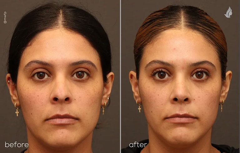 Front View Cosmetic Rhinoplasty before and after photo by Dr. Griffin