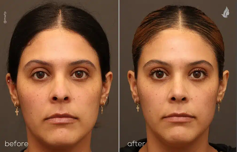 Front View Cosmetic Rhinoplasty before and after photo by Dr. Griffin