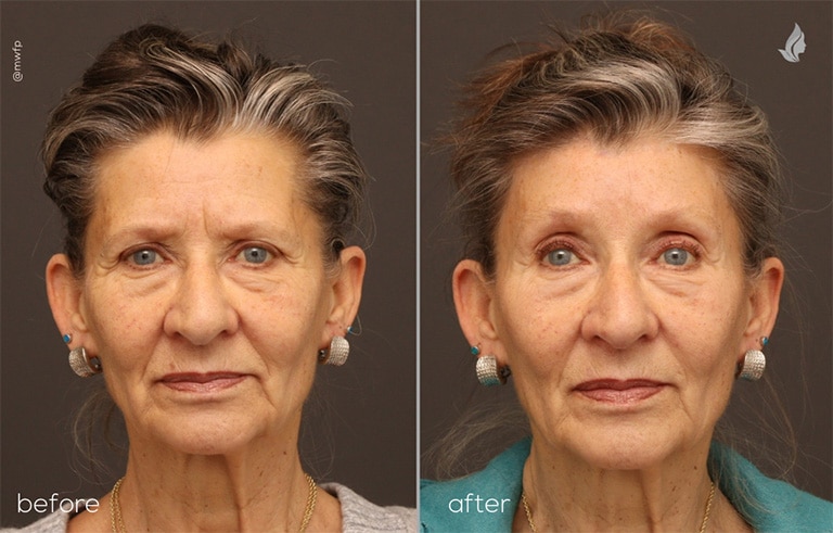 Front View Upper Blepharoplasty and Brow Lift before and after photo by Dr. Tolan