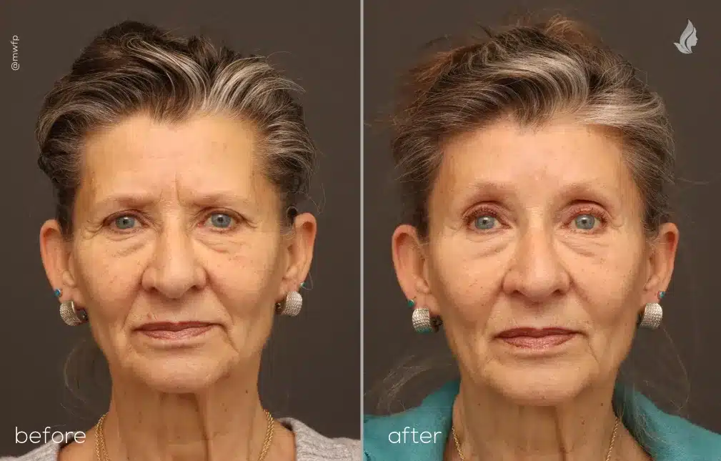 Front View Upper Blepharoplasty and Brow Lift before and after photo by Dr. Tolan