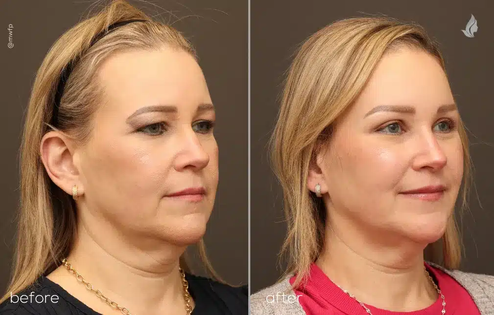 Right Oblique View Blepharoplasty and Brow Lift before and after photo by Dr. Bakeman
