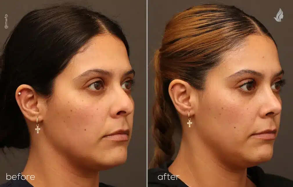 Right Oblique View Cosmetic Rhinoplasty before and after photo by Dr. Griffin