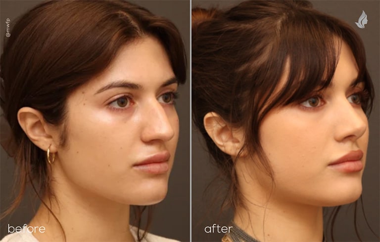 Right Oblique View Rhinoplasty before and after photo by Dr. Griffin