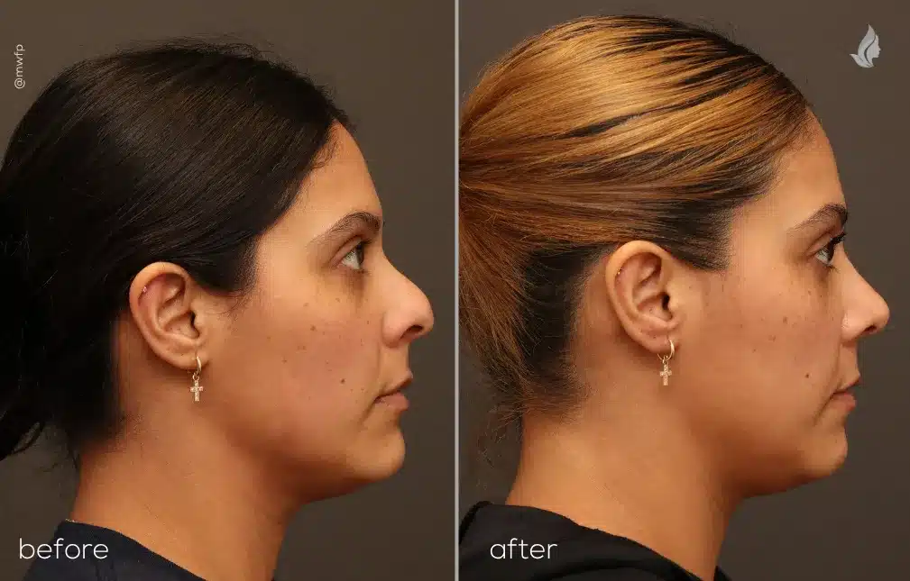 Right Side View Cosmetic Rhinoplasty before and after photo by Dr. Griffin