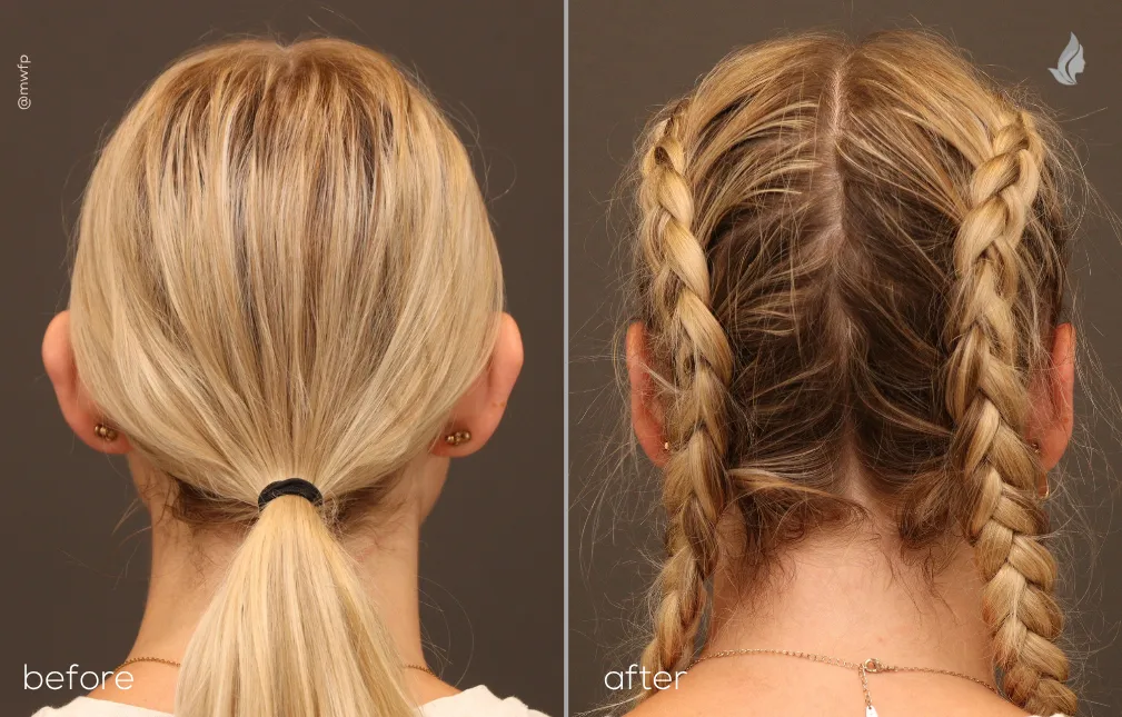 Back View otoplasty before and after photo by Dr. Bakeman