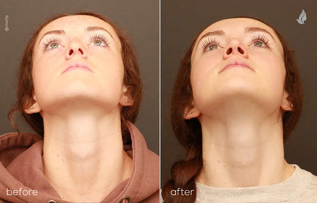 Base View rhinoplasty before and after photo by Dr. Bakeman