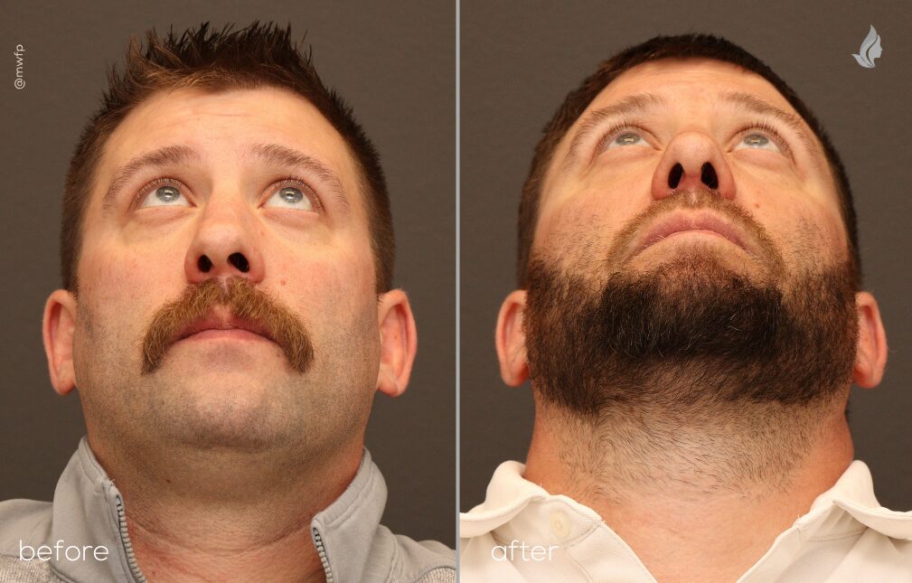 Base before and after Rhinoplasty by Dr. Sciegienka