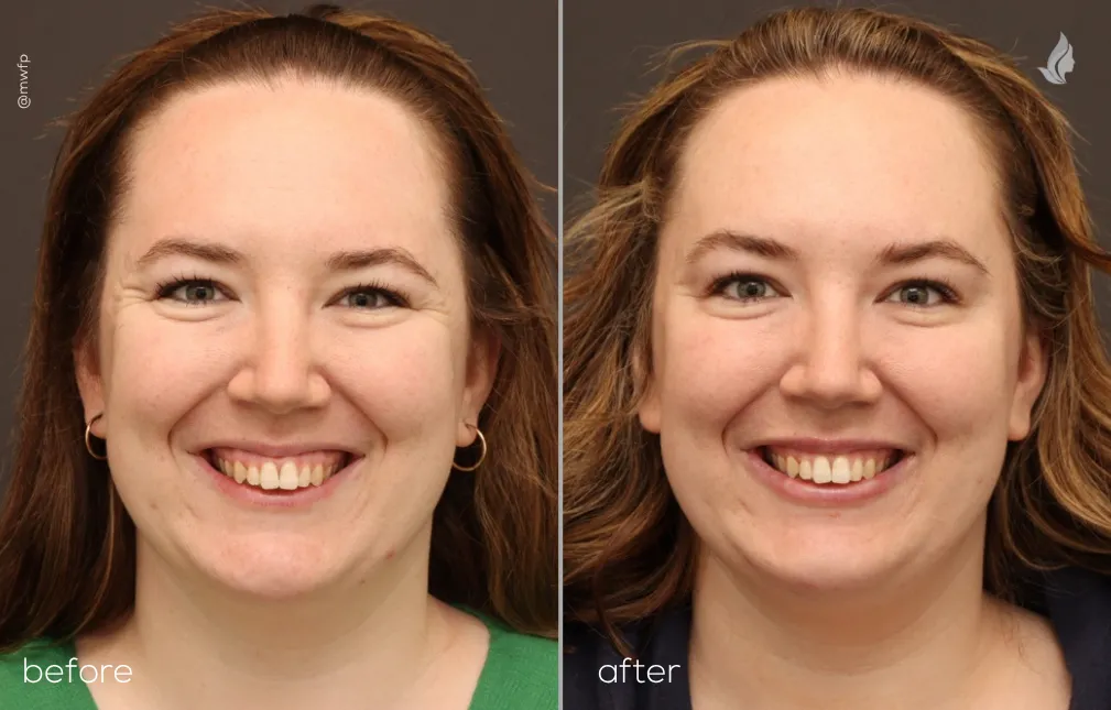 Before and After Botox & Filler Front by Angela V