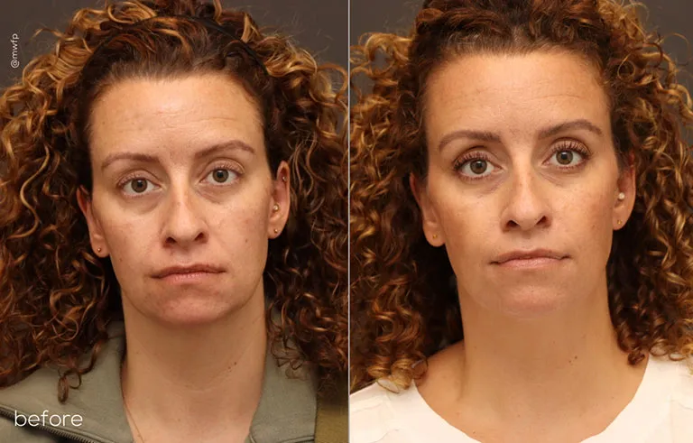 Botox & Filler Front before after by Angela V