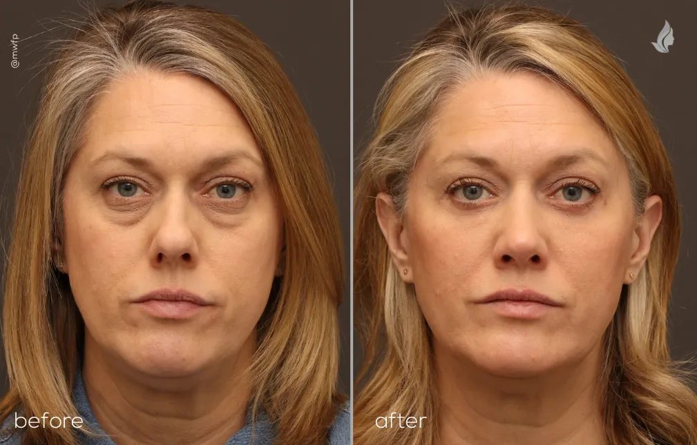 Front View Blepharoplasty and Rhinoplasty before and after by Dr. Bakeman