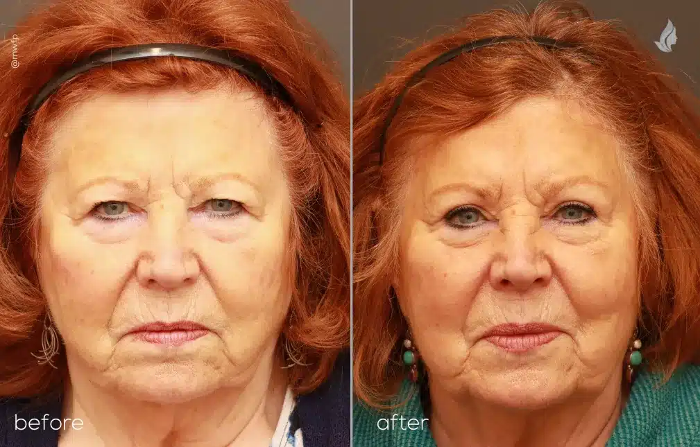 Front View Browlift & Upper Blepharoplasty by Dr. Griffin