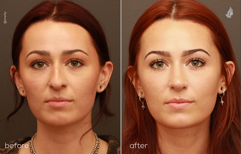 Front View Cosmetic and functional Rhinoplasty before and after by Dr. Griffin