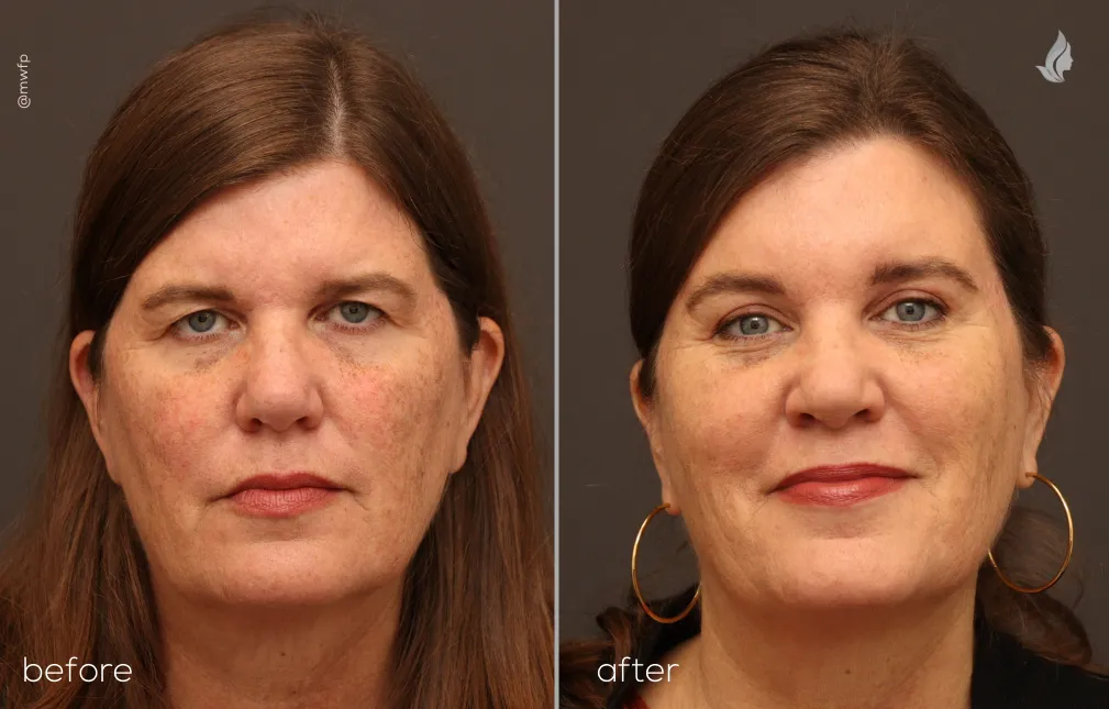 Front View Endobrow & Upper Blepharoplasty before and after by Dr. Farhood