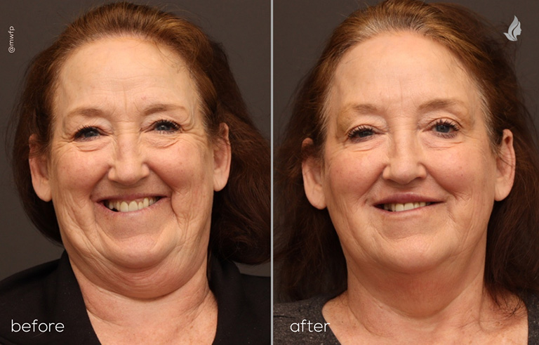 Front View Full Face Botox & Filler Refresh before and after by Angela V