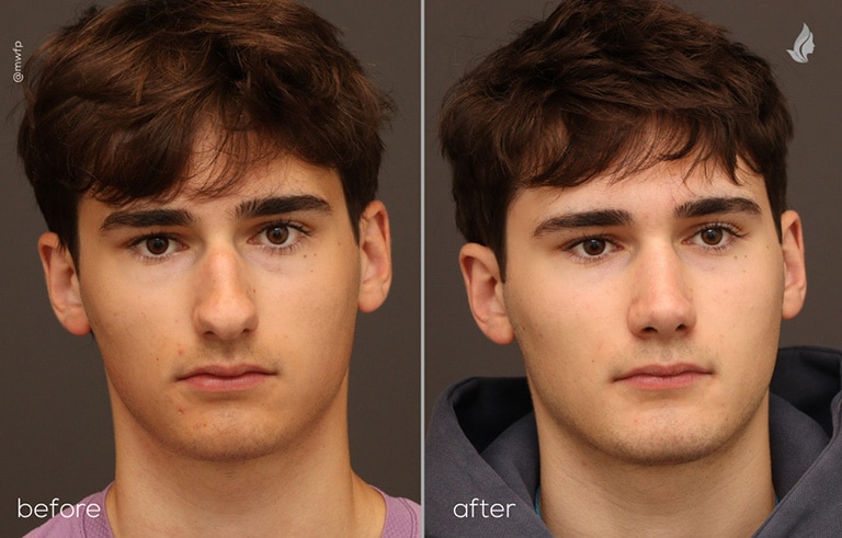 Front View Functional Cosmetic Rhinoplasty before and after by Dr. Griffin