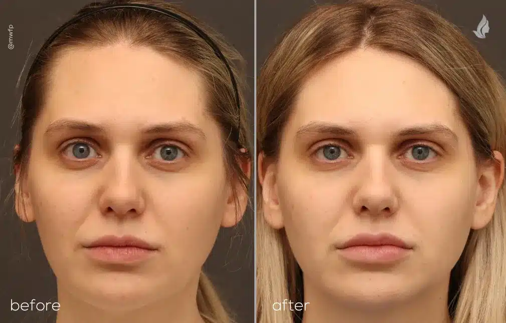 Front View Lip Filler before and after by Angela V