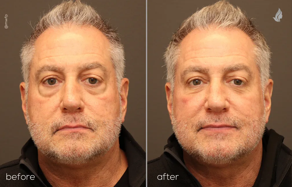 Front View Lower Blepharoplasty by Dr. Farhood