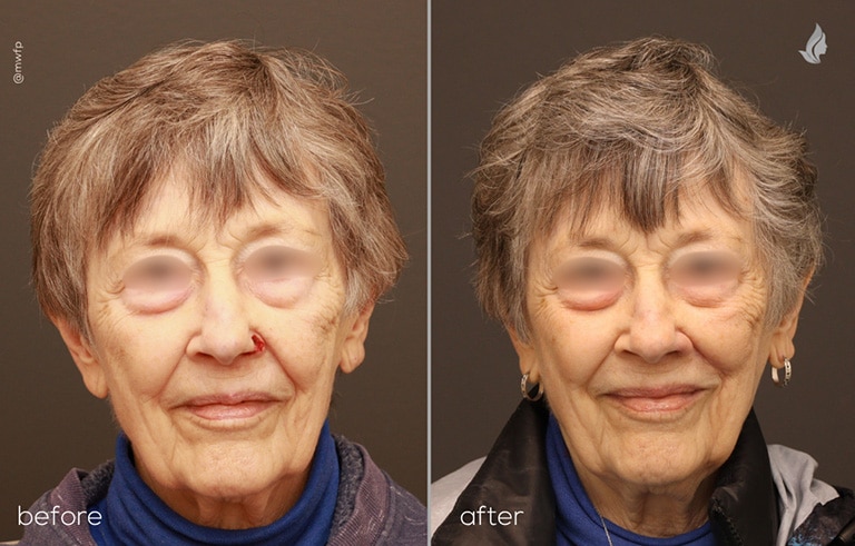 Front View MOH Surgery before and after by Dr. Farhood