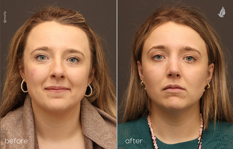 Front View Rhinoplasty before and after by Dr. Farhood