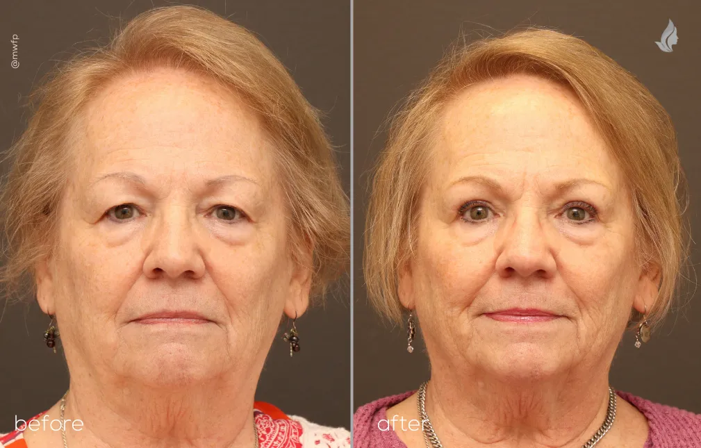 Front View Upper Blepharoplasty before and after by Dr. Griffin