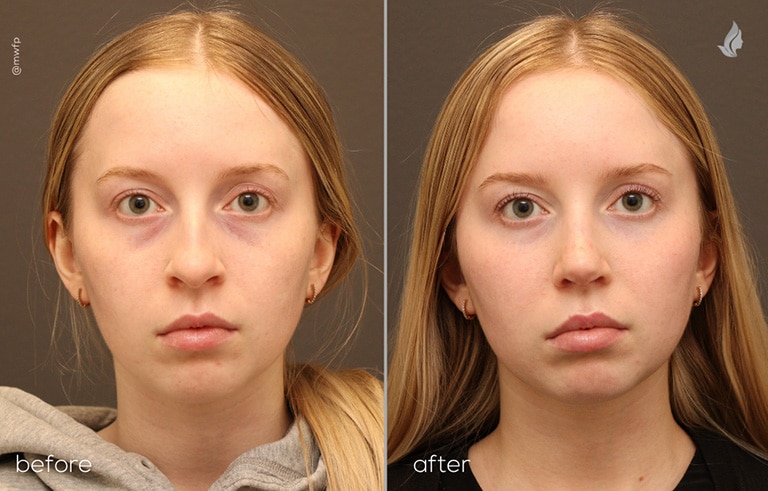 Front View autologous fat grafting & rhinoplasty before and after photo by Dr. Griffin
