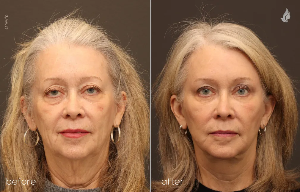 Front View before and after Facelift, temporal brow lift, bilateral upper eyelid by Dr. Tolan