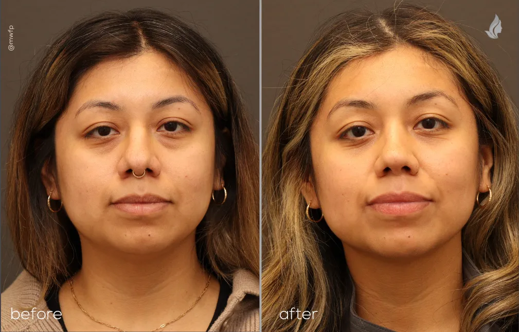 Front View before and after Rhinoplasty & Lower blepharoplasty by Dr. Farhood