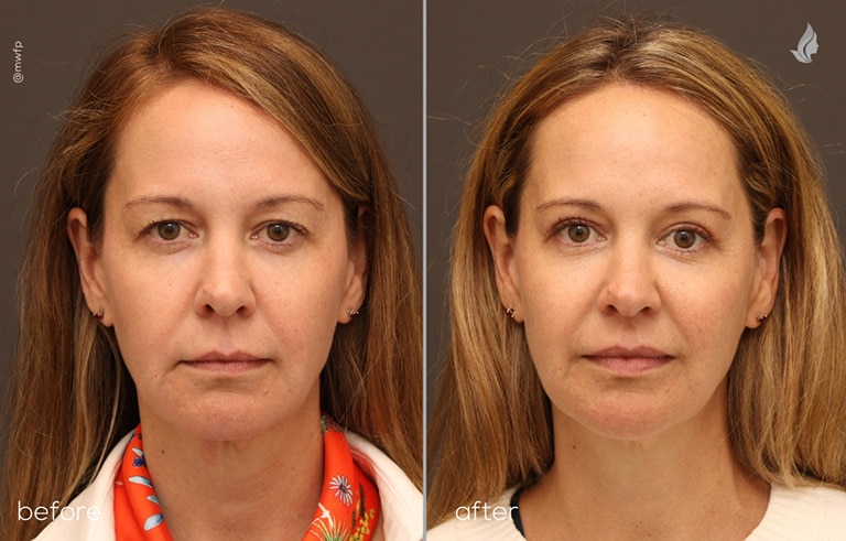Front View blepharoplasty before and after photo by Dr. Griffin
