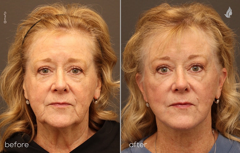 Front View browlift, deep plane facelift & neck lift before and after photo by Dr. Farhood