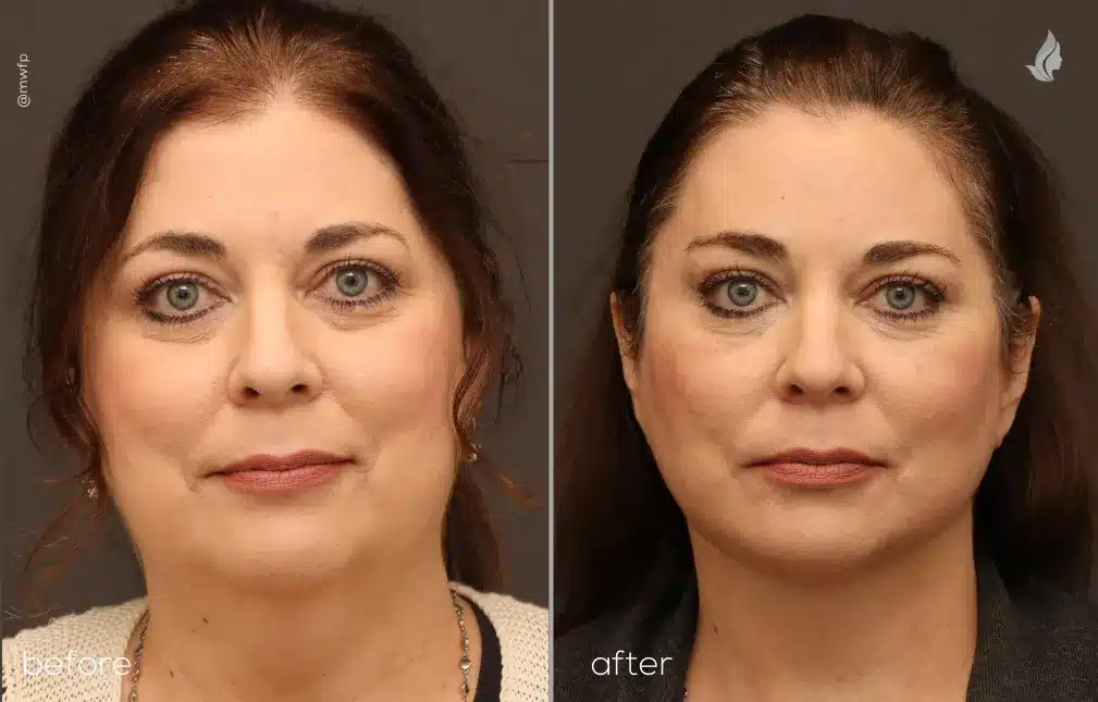 Front View deep plane face lift and neck lift before and after by Dr. Farhood