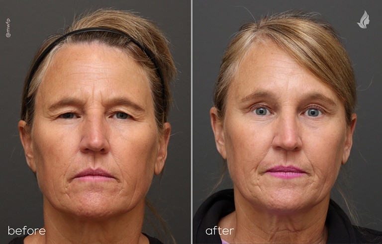 Front View endoscopic brow lift and upper blepharoplasty before and after by Dr. Sciegienka