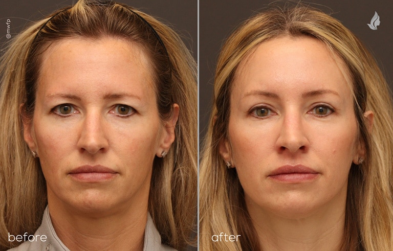Front View endoscopic brow lift and upper blepharoplasty before and after photo by Dr. Bakeman