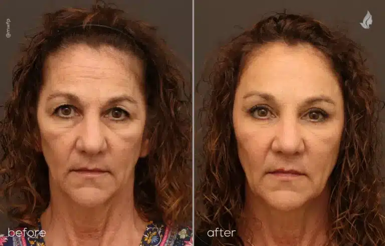 Front View endoscopic brow lift, upper blepharoplasty, midface fat transfer before and after photo Front View endoscopic brow lift, upper blepharoplasty, midface fat transfer before and after photo