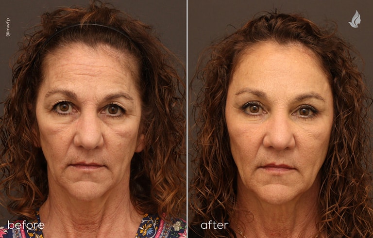 Front View endoscopic brow lift, upper blepharoplasty, midface fat transfer before and after photo by Dr. Farhood