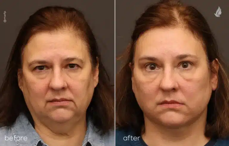 Front View face, neck lift, upper blepharoplasty & endoscopic brow lift before and after Front View face, neck lift, upper blepharoplasty & endoscopic brow lift before and after