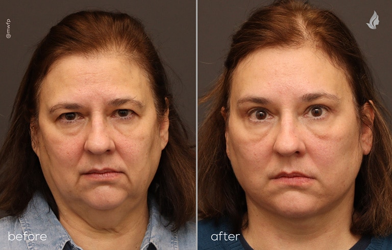 Front View face, neck lift, upper blepharoplasty & endoscopic brow lift before and after by Dr. Farhood