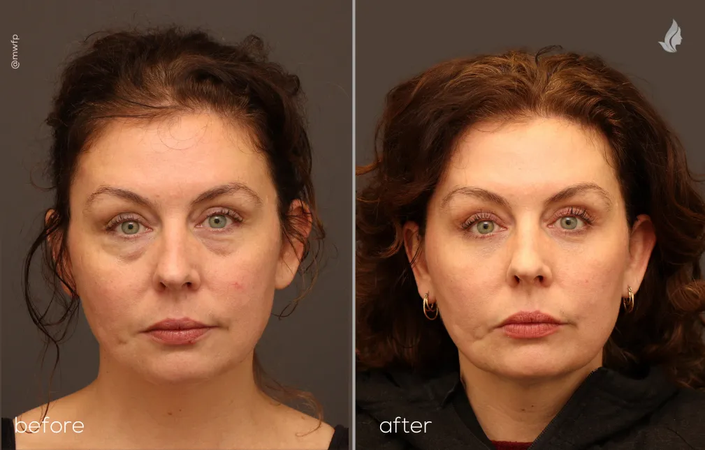 Front View lower blepharoplasty by Dr. Farhood