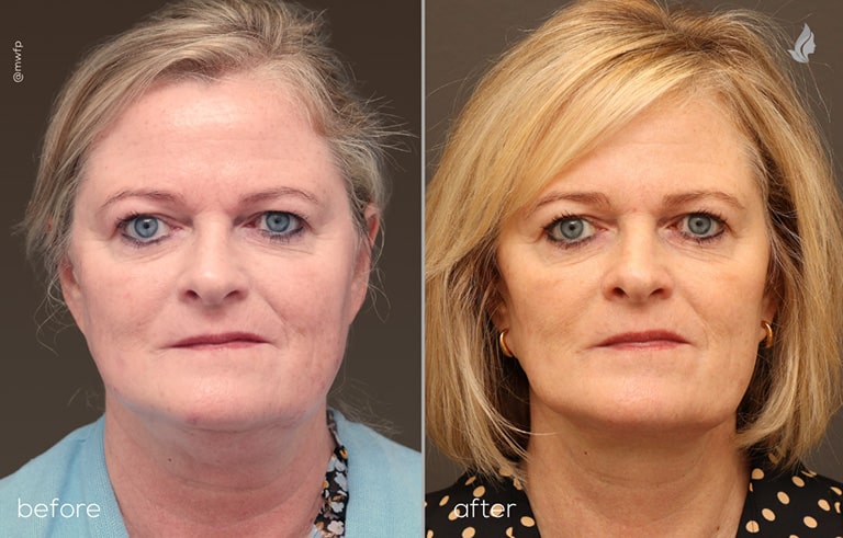 Front View neck lift before and after photo by Dr. Tolan