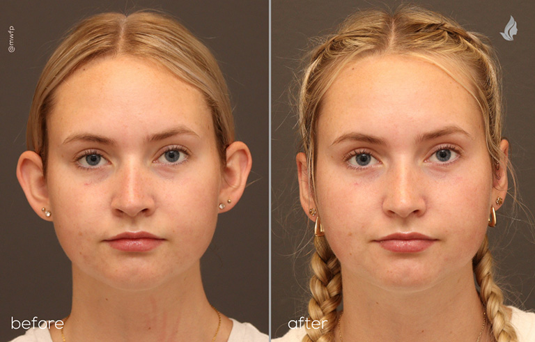 Front View otoplasty before and after photo by Dr. Bakeman