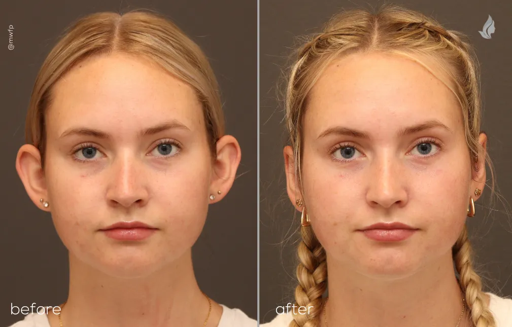 Front View otoplasty before and after photo by Dr. Bakeman