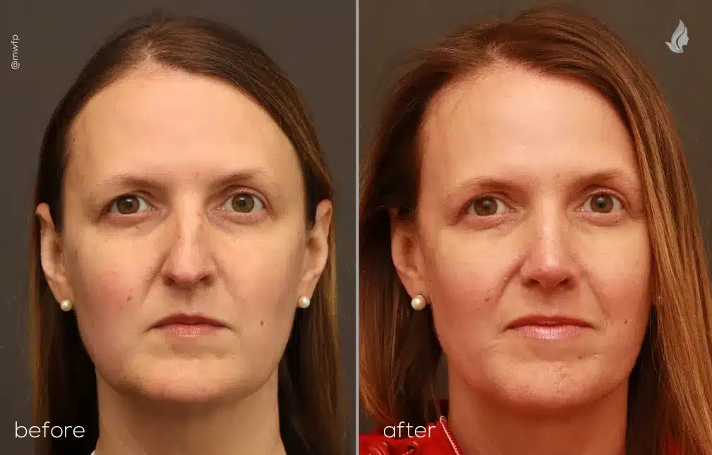 Front View rhinoplasty before and after by Dr. Griffin