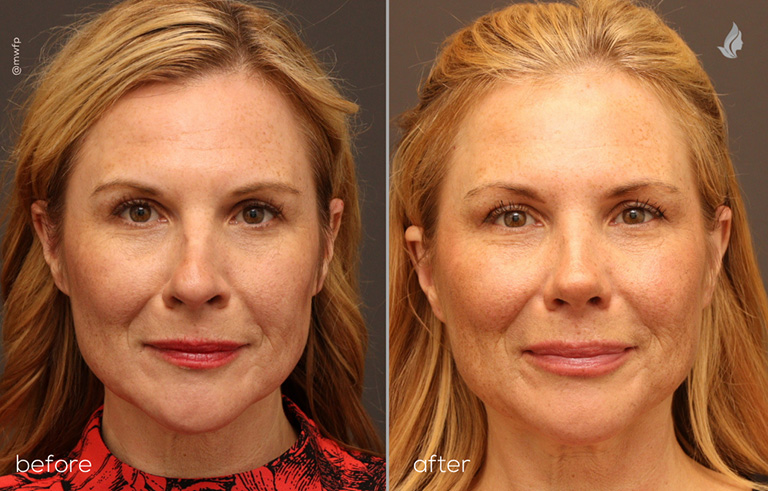 Front View rhinoplasty before and after photo by Dr. Bakeman